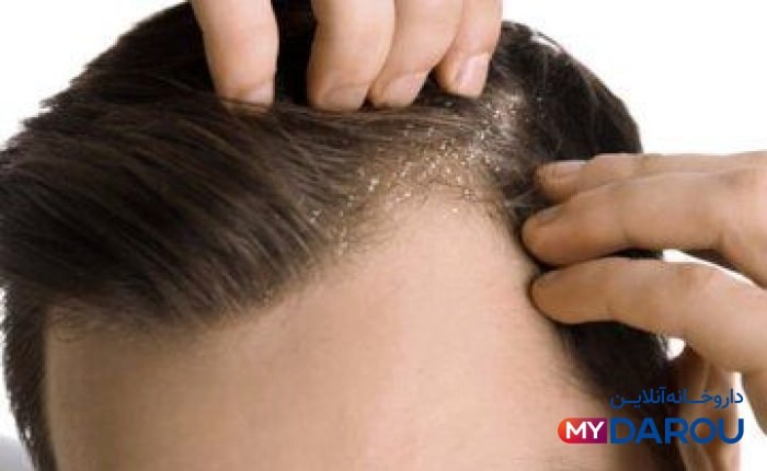  بهترین شامپو ضد شوره و ضد ریزش برای مو های چرب 